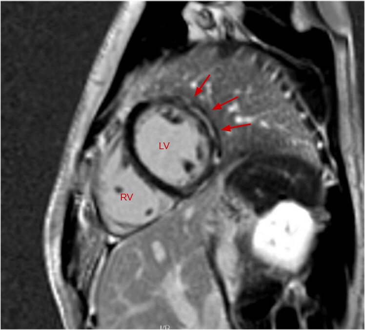 A reconsidered diagnosis in an unresolving myocarditis-a case report.
