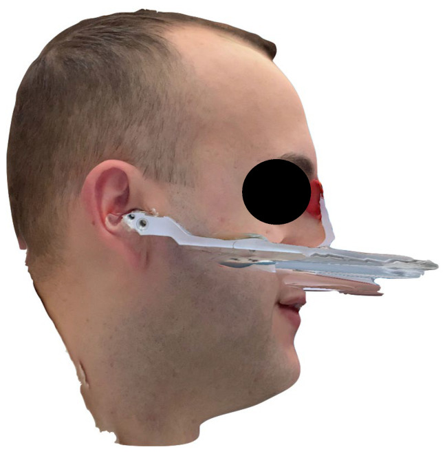 A Digital Workflow for Virtual Articulator Mounting Using Face Scan and Facebow Capture: A Proof-of-Concept.