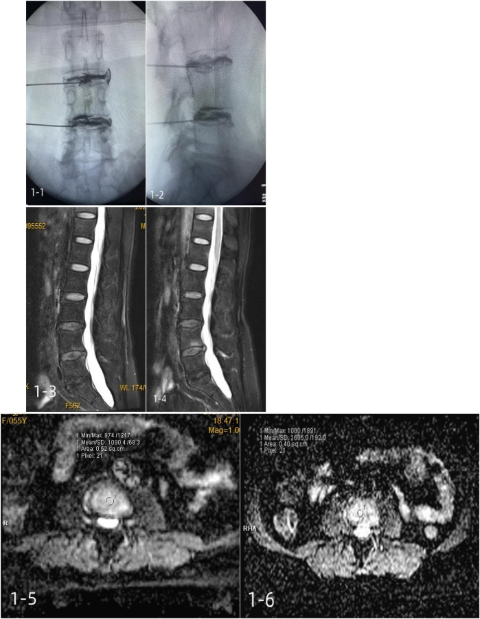 Platelet-rich plasma for the treatment of discogenic low back pain: a prospective randomized controlled trial.