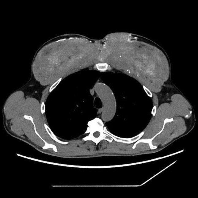 Intramuscular synthol injections cause hypercalcemia in long-term observation: a case report study.