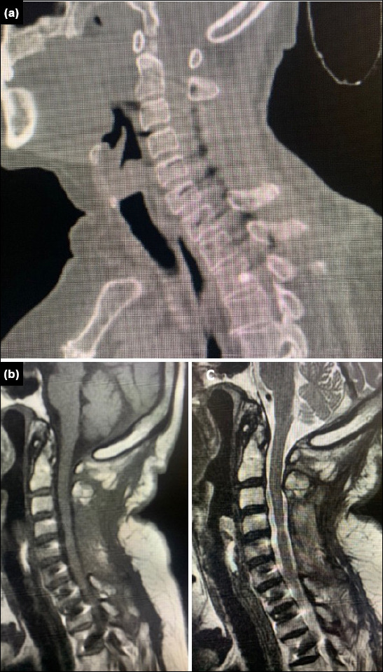 Outcome of cervical cases operated with posterior cervical pedicle screw placement: a single-center retrospective study.