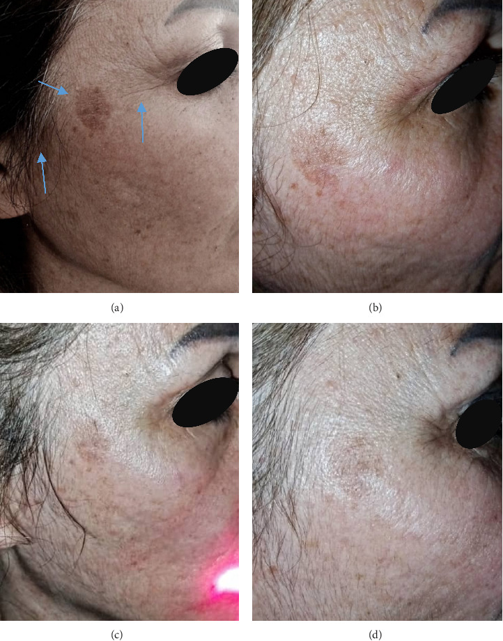 Low-Level Laser Therapy as an Effective Intervention for Facial Pigmentation: A Case Report of Ephelides and Lentigines in Syrian Women.