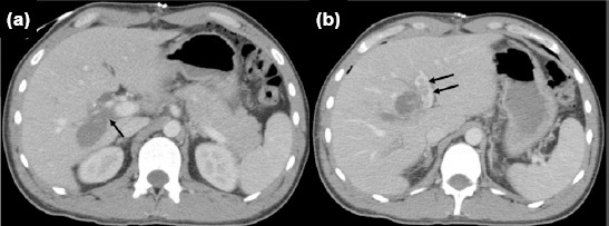 Tangential gunshot injury of the right portal vein branch resulting in subacute main portal vein thrombosis: Successful treatment without hepatectomy