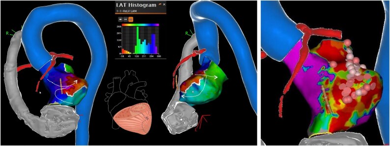 Sympathectomy in refractory ventricular arrhythmias in patients with left ventricular assist device: a grand round case report.