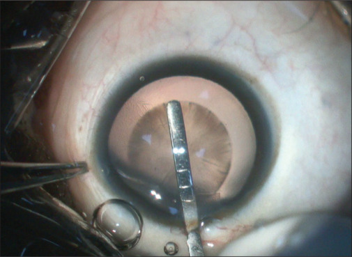 The "3-6 spatula": Customizing intraocular measurements.