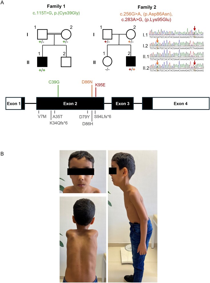 Novel missense variants in CFL2 affect F-actin depolymerisation and expand the disease spectrum of CFL2-related myopathy.