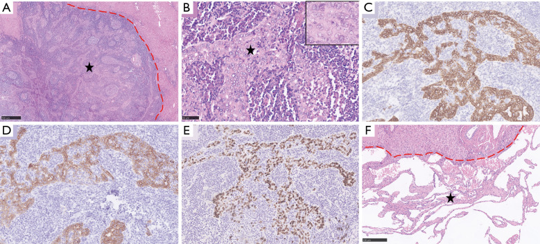 Primary Epstein-Barr virus-positive inflammatory follicular dendritic cell sarcoma concurrent with lymphoepithelioma-like intrahepatic cholangiocarcinoma and cavernous hemangioma in liver.