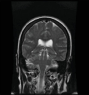 Delayed Posthypoxic Leukoencephalopathy in a Catatonic-Appearing Patient: A Case Report.
