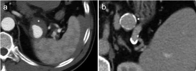 Growth dynamics of splenic artery aneurysms: morphology, comorbidities, and vascular anatomical factors.