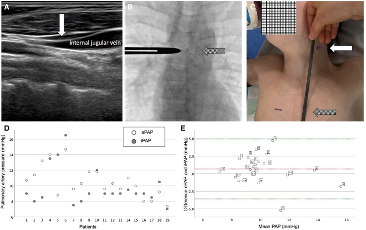 A novel technique for non-invasive assessment of pulmonary artery pressure in patients after the Fontan procedure.