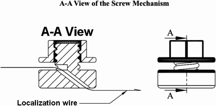 A 3D-printed screw mechanism as an alternative method to prevent wire migration in nonpalpable breast lesion localization.