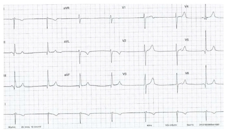 Severe Bradyarrhythmia and Reduced Cardiac Output Due to Oral Baclofen Withdrawal in a 24-Year Old Man: A Case Report.