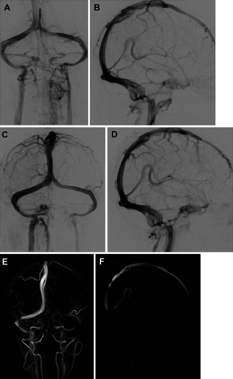 Increased systemic venous pressure leading to intracranial hypertension in a patient with a ventriculoatrial shunt: illustrative case.