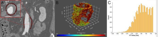 Association between perivascular fat density on CT angiography and abdominal aortic aneurysm progression.