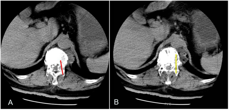 Percutaneous Vertebroplasty Using GeneX<sup>®</sup> in Osteoporotic Vertebral Compression Fractures: A Case Report.