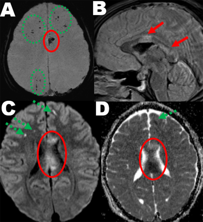 Moderate and severe traumatic brain injury: abbreviated injury scale scoring and coding of traumatic axonal injury from early MRI.