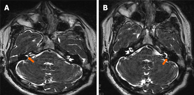 Role of imaging in chronic otitis media and its complications.