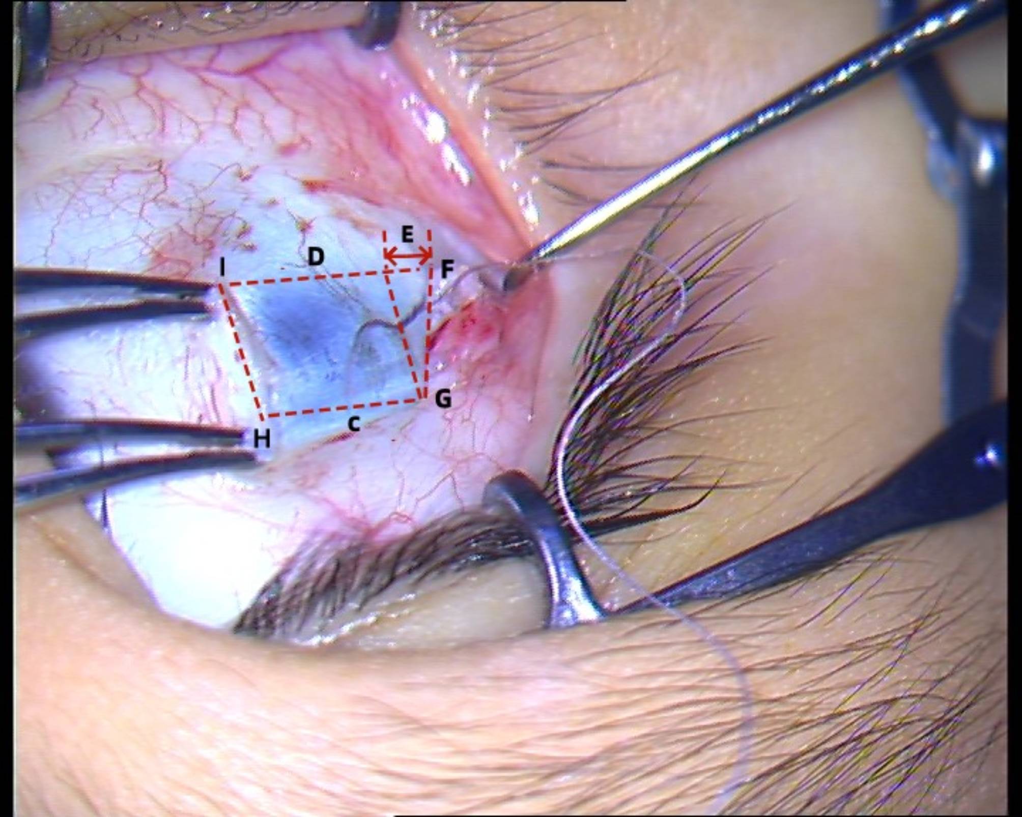 Impact of slanted lateral rectus recession on pediatric patients with convergence insufficiency intermittent exotropia.