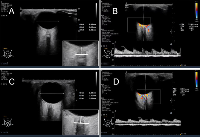 A prospective study of transorbital ultrasound multimodal imaging in the detection and evaluation of increased intracranial pressure.