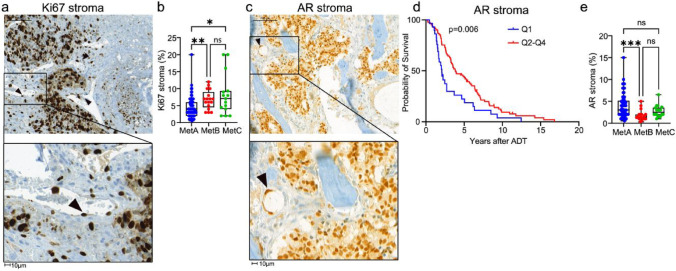 Morphological heterogeneities in prostate cancer bone metastases are related to molecular subtypes and prognosis.