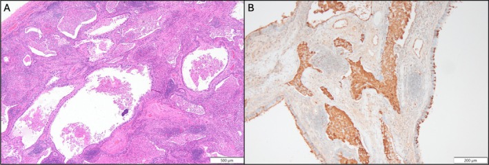 A Case of Hybrid of Congenital Pulmonary Airway Malformation and Anomalous Systemic Blood Supply Presenting Elevated Serum Levels of Carbohydrate Antigen 19-9.