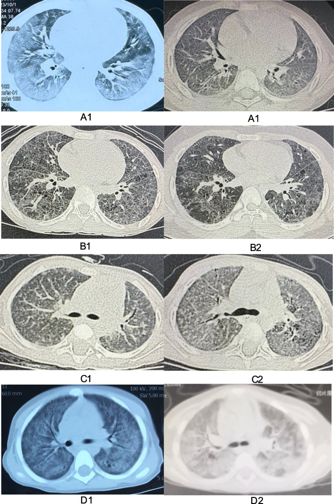 A comparative analysis of clinical phenotypes and outcomes in childhood interstitial lung disease due to surfactant dysfunction disorders: focusing on mutations in SFTPC, ABCA3, and NKX2-1 genes.