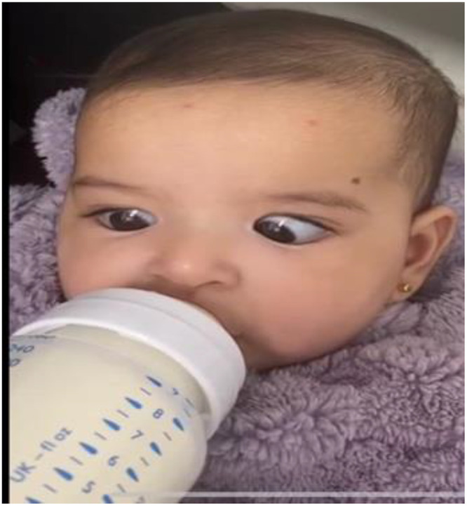 Marcus-Gunn Jaw-Winking Phenomenon: A Case Report on Rare Oculofacial Synkinesis.