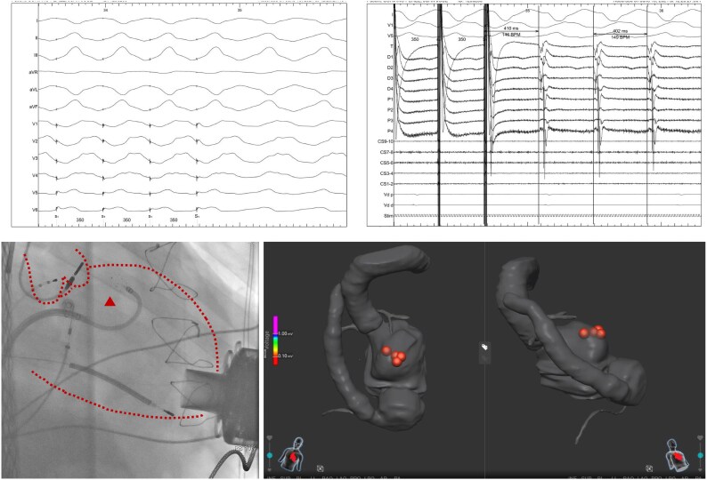 Sympathectomy in refractory ventricular arrhythmias in patients with left ventricular assist device: a grand round case report.