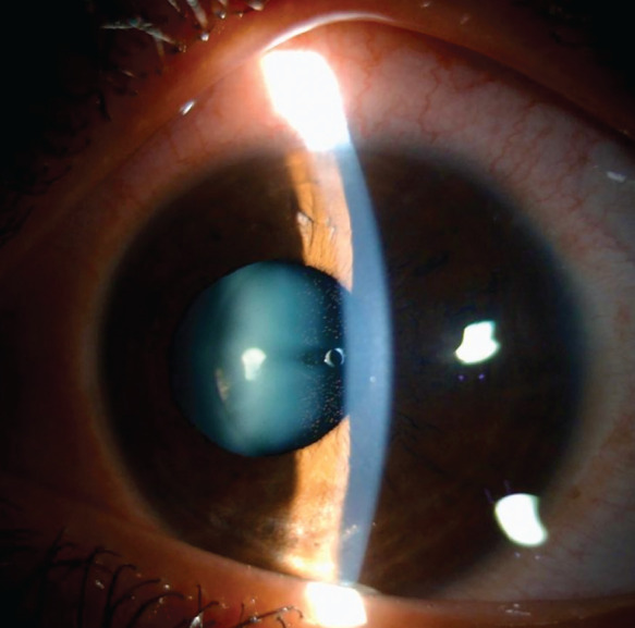 Urrets-Zavalia Syndrome After Posterior Chamber Phakic Intraocular Lens Implantation: An Unusual Complication.
