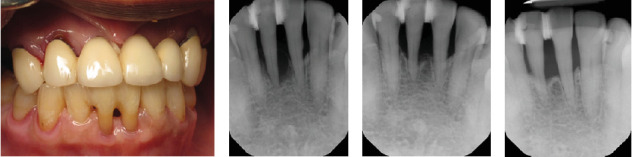 Maintenance of Periodontally Compromised Teeth Using Periodontal Splints.