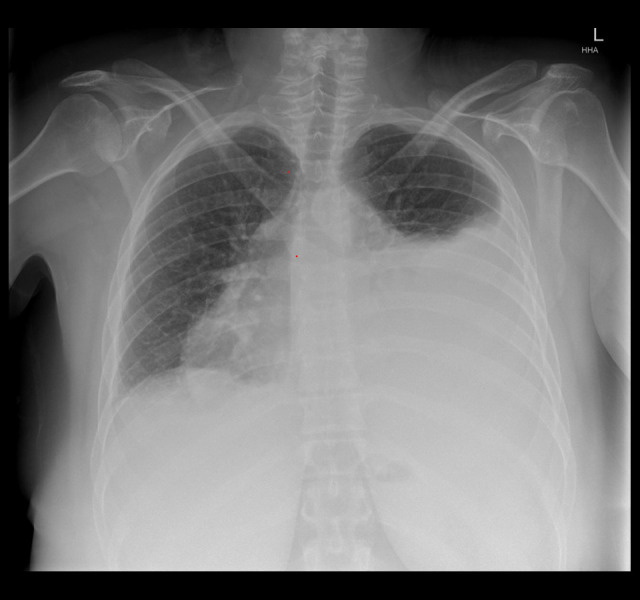 Management of Cardiac Tamponade During Systemic Lupus Erythematosus Flare with Significant Pericardial Effusion: A Case Report.