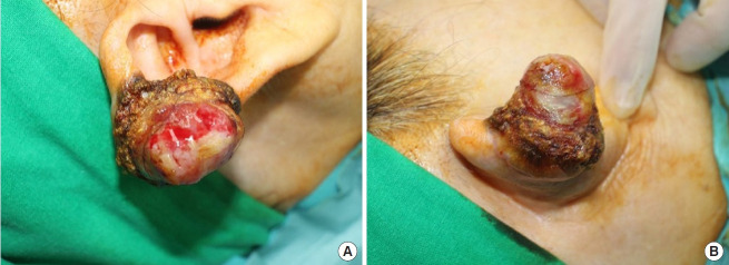 Sarcomatoid squamous cell carcinoma arising in a post-acupuncture keloid scar: a case report and literature review.
