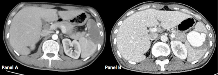 Delayed Giant Splenic Artery Aneurysm Following Splenic Infarction in a Patient with Infective Endocarditis.