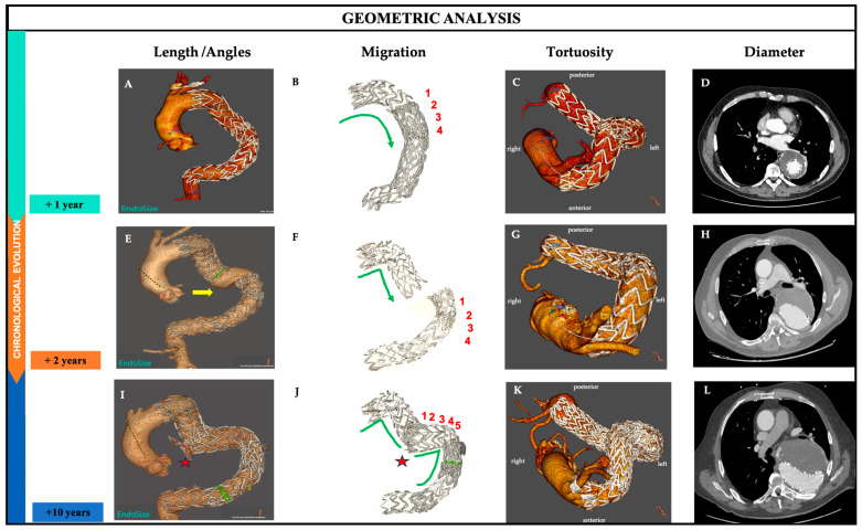 Geometric Aortic Remodeling and Stent-Graft Migration After TEVAR: Insights from Longitudinal 3D Analysis and Literature Review.