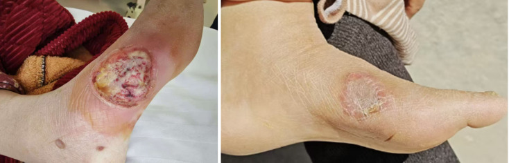 Vitamin D supplementation reduces infection rate and promotes wound healing in patients with diabetic foot ulcers.