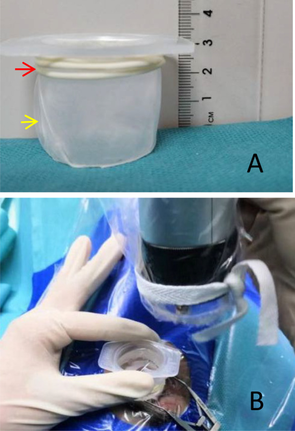 Intraoperative UBM-guided direct cyclopexy for traumatic cyclodialysis cleft: a four-case series.