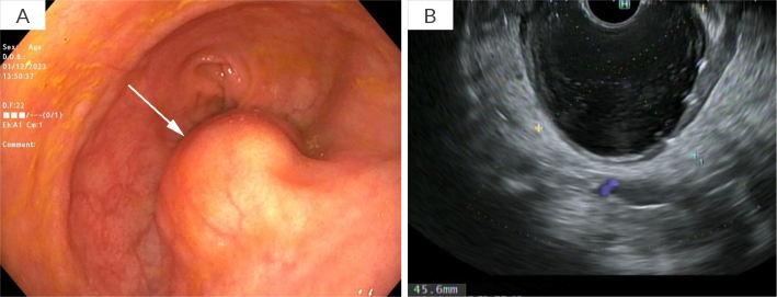 Endoscopic Ultrasound-Guided Drainage of Extraluminal Colorectal Mucocele Using A Lumen-Apposing Metal Stent: A Novel Approach.