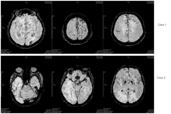 Cerebral inflammatory amyloid angiopathy: response to treatment.