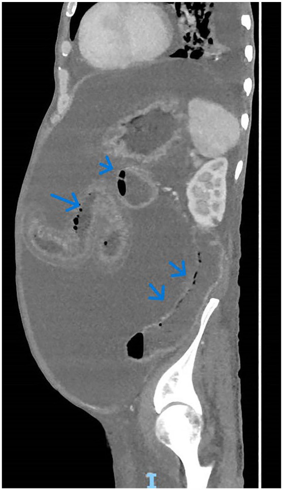 Pneumatosis Intestinalis Detected by Point of Care Ultrasound, Case Report.