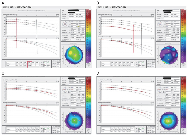 Managing Pseudophakic Corneal Edema: Structural Changes and Preliminary Observations on Coenzyme Q10 Use.