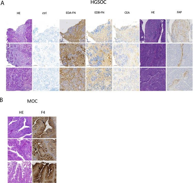 A comparative analysis of tumor markers reveals EDA fibronectin as a promising target in high-grade serous ovarian cancer.