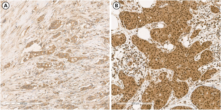 CD39 and CD73 Expression in Breast Cancer: CD73 as a Favorable Prognostic Factor in HER2-Positive Tumors.