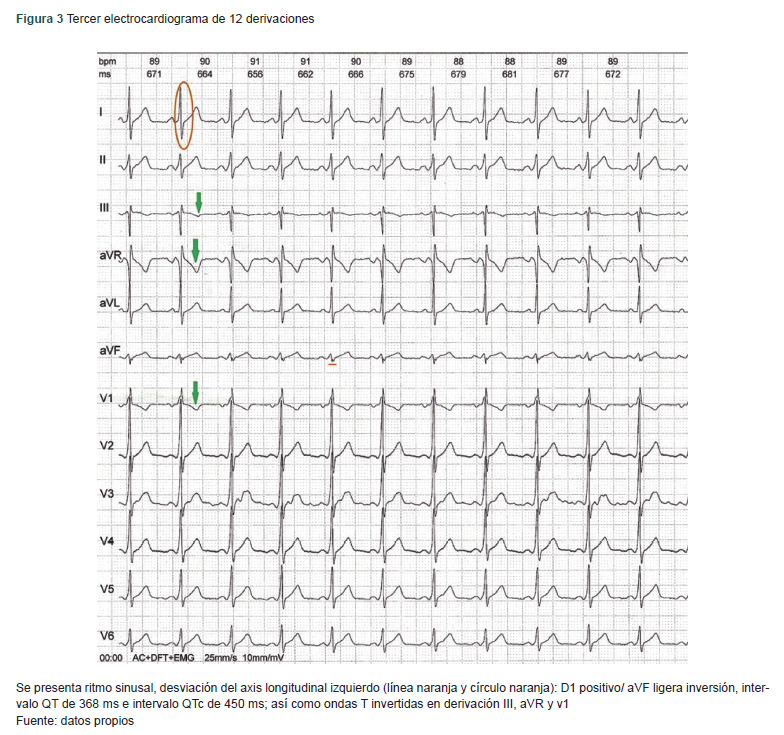 [Wolff-Parkinson-White syndrome due to cocaine use: a case report].