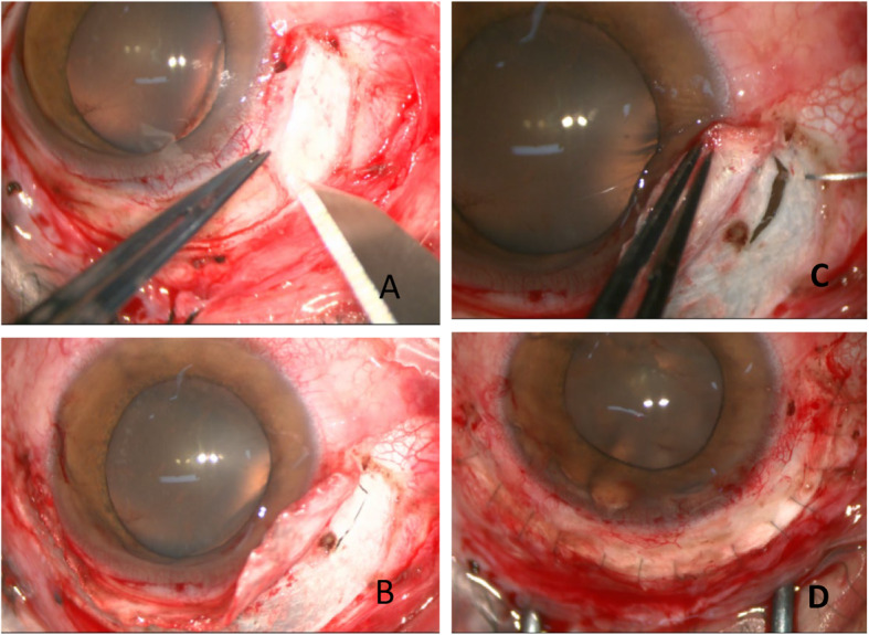 Intraoperative UBM-guided direct cyclopexy for traumatic cyclodialysis cleft: a four-case series.