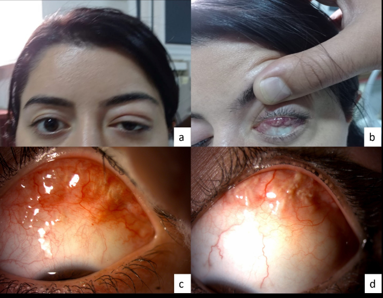Orbital Presentation of Eosinophilic Granulomatosis with Polyangiitis: An Interventional Case Report and Literature Review.