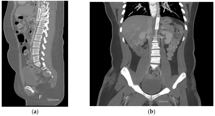 A Rare Case of Aortic Dissection 10 Years Post Percutaneous Catheterization Retrieval of an Embolized PDA Device in a Patient with Down Syndrome.