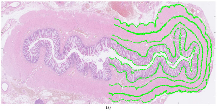 Histoanatomic Features Distinguishing Aganglionosis in Hirschsprung's Disease: Toward a Diagnostic Algorithm.