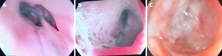 Isolation techniques for gastrointestinal tract defects: Two case reports.