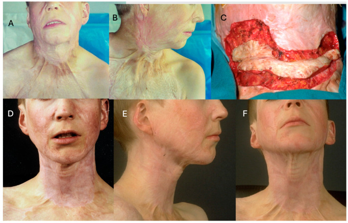 Use of Integra<sup>®</sup> Dermal Regeneration Template Bilayer in Burn Reconstruction: Narrative Review, Expert Opinion, Tips and Tricks.