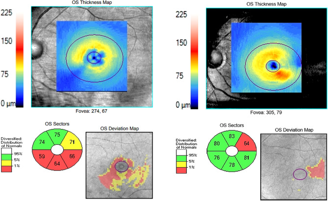 Ganglion cell layer changes following the idiopathic macular hole surgery using inverted limiting membrane flap technique.